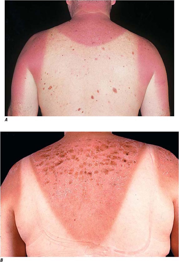 The deck's own before-and-after: A acute sunburn, sharply demarcated at the clothing line; B the same back 48 hours later, now blistered and desquamating. Slide 92.