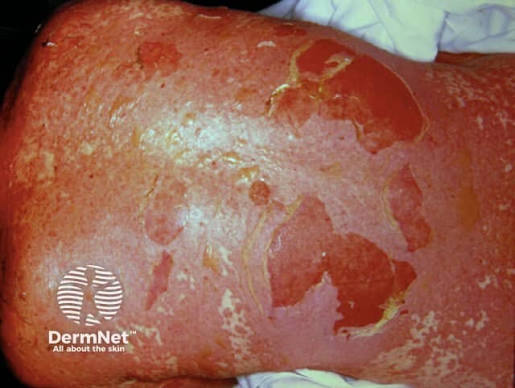 Sheets of detaching epidermis, the wet parchment appearance. Extent of this is what sets the diagnosis. Slide 86.