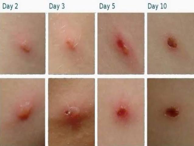 One lesion followed from day 2 to day 10. In a real patient lesions at each of these points are present at the same time. Slide 85.