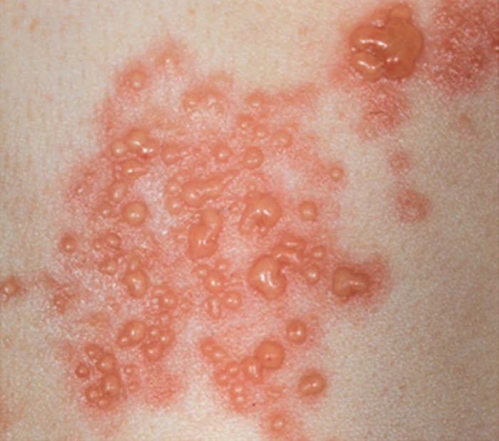 The acute eruptive phase: grouped herpetiform vesicles on an erythematous base, the classic finding. Slide 101.
