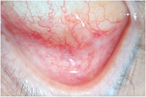 Autoimmune conjunctivitis &mdash; Recurrent redness with scarring of the fornix