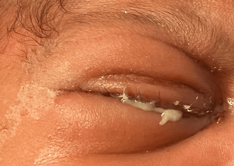 Chlamydial conjunctivitis &mdash; neonatal &mdash; Conjunctivitis in a neonate, days after birth
