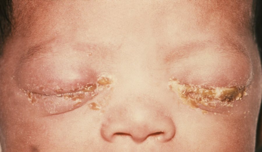Gonococcal conjunctivitis &mdash; Severe purulent discharge, hyperacute over hours