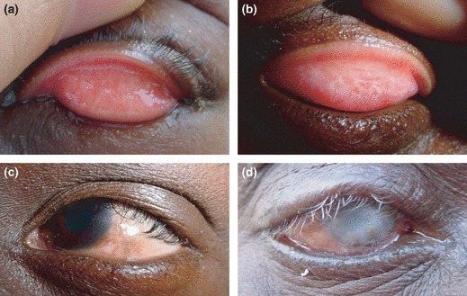 Trachoma &mdash; Upper lid follicles, then scarring that turns the lid in
