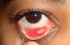 Chalazion &mdash; Focal, NON-tender lid swelling built over days to weeks