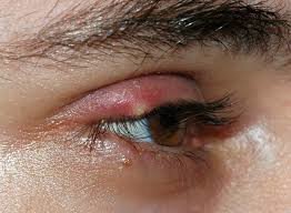 Hordeolum (stye) &mdash; TENDER nodule &mdash; internal, pointing on the inner lid surface