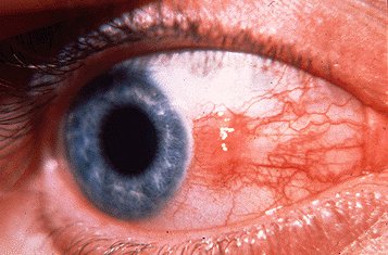 Pinguecula &mdash; Yellow nodule on the conjunctiva that STOPS at the limbus