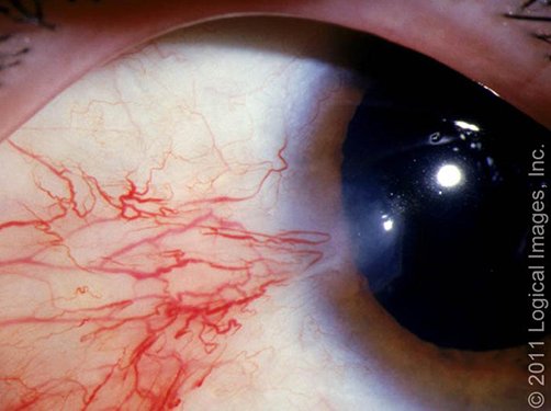 Pterygium &mdash; Wing of tissue that has CROSSED onto the cornea