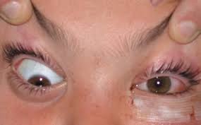 Post-septal (orbital) cellulitis &mdash; PROPTOSIS with restricted, painful eye movement