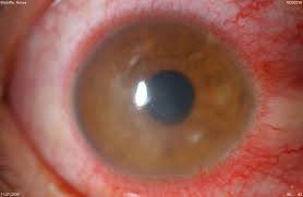 Keratitis &mdash; Corneal opacification with ciliary flush around the limbus