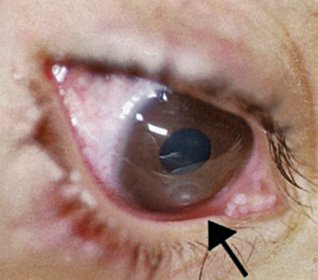 Corneal ulcer &mdash; White corneal infiltrate with an overlying epithelial defect