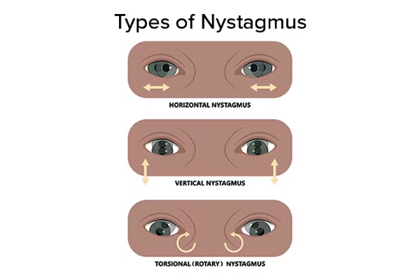 Nystagmus &mdash; Involuntary rhythmic oscillation, named for the FAST beat