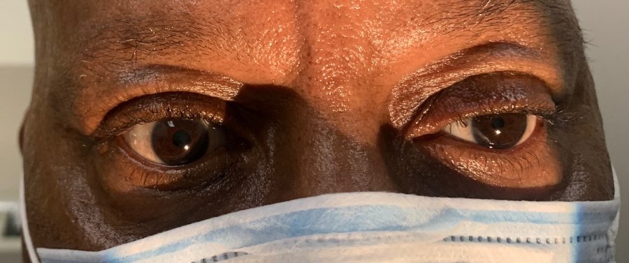 Horner syndrome &mdash; Ptosis and miosis on the same side