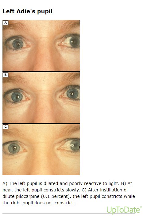 Adie tonic pupil &mdash; The LARGER pupil, reacting poorly to light
