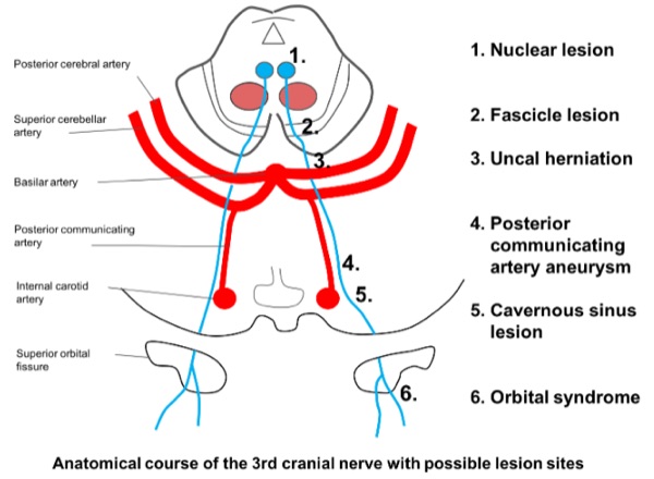Diagram of the third cranial nerve's course from midbrain to orbit, with six numbered lesion sites.