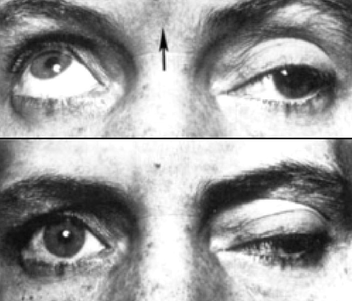 Cranial nerve III palsy &mdash; Ptosis with the eye down and out, pupil dilated