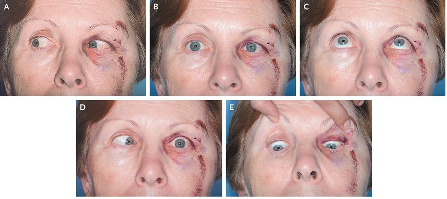 Cranial nerve VI palsy &mdash; The affected eye will not abduct
