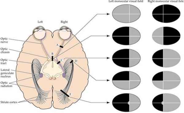 Visual pathway from retina to striate cortex with the field defect produced by a lesion at each point.