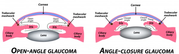 Acute angle-closure glaucoma &mdash; HAZY cornea with a fixed mid-dilated pupil
