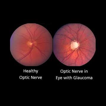 Chronic open-angle glaucoma &mdash; OPTIC NERVE CUPPING, with the rim thinned
