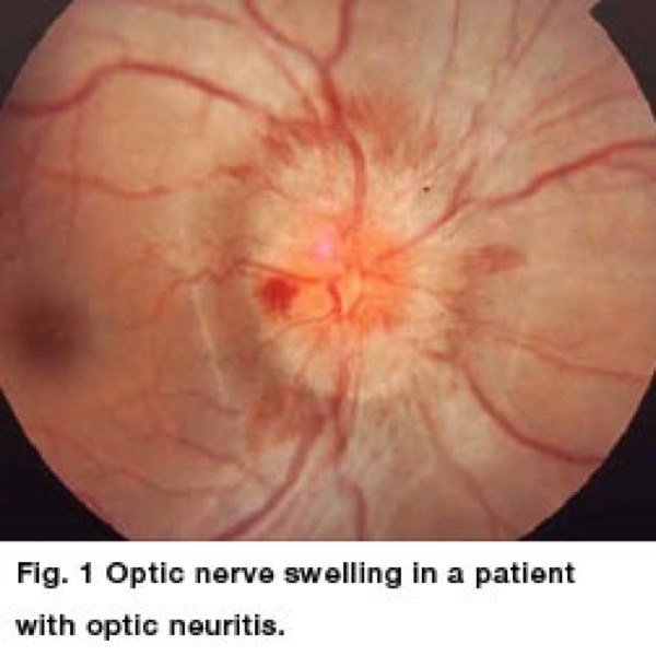 Optic neuritis &mdash; the disc &mdash; Disc swelling &mdash; but it looks like any swollen disc, so it is not diagnostic