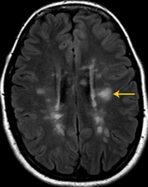 Optic neuritis &mdash; the MRI &mdash; Periventricular T2 FLAIR lesions &mdash; the demyelination behind it