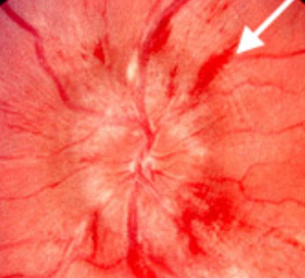 Papilledema &mdash; acute &mdash; Acute: blurred disc margins with flame hemorrhages