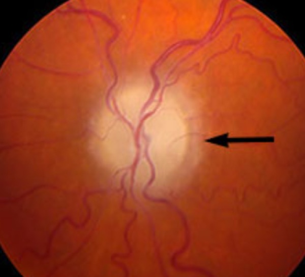 Pale optic disc with tortuous vessels, arrowed.