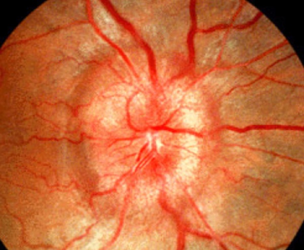 Papilledema &mdash; chronic &mdash; Chronic: disc elevation and blurred margins, no hemorrhages
