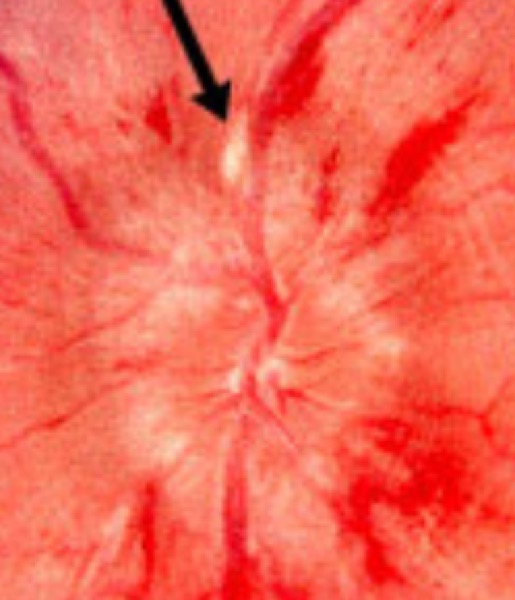 Swollen optic disc with a cotton wool spot, arrowed.