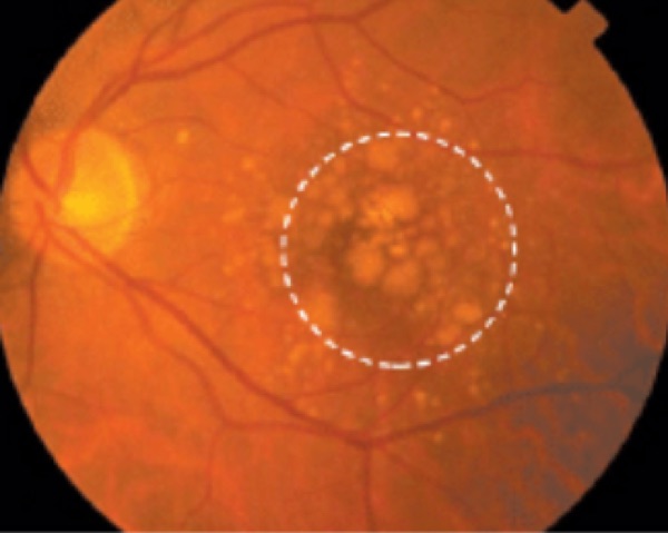 Age-related macular degeneration &mdash; dry &mdash; Soft drusen &mdash; large, pale, indistinct deposits at the macula
