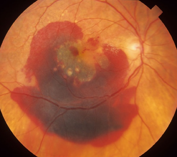 Age-related macular degeneration &mdash; wet &mdash; Hemorrhage from new choroidal vessels bleeding into the retina