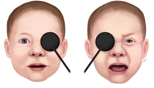Amblyopia &mdash; Occlusion objection &mdash; content until the GOOD eye is covered