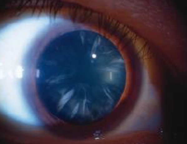 Cataract &mdash; cortical &mdash; Spokes running in from the lens edge