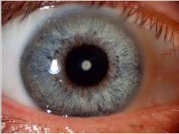 Cataract &mdash; pediatric &mdash; Polar cataract &mdash; a discrete opacity at the lens pole