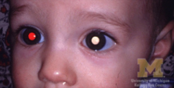 Retinoblastoma &mdash; Leukocoria &mdash; one pupil red, the other white