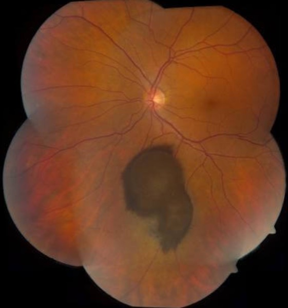 Uveal melanoma &mdash; Choroidal melanoma &mdash; a dome of pigment under the retina