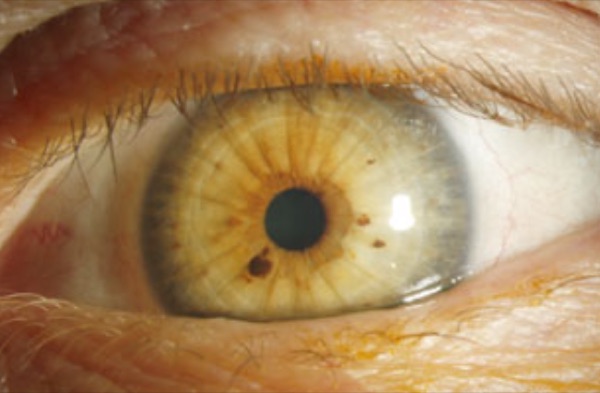 Iris nevus &mdash; Flat, under 3 mm, and no vessel of its own