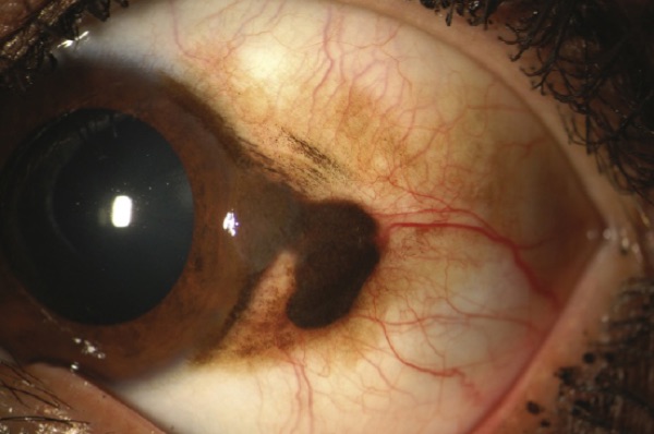 Conjunctival melanoma &mdash; Raised and vascular, unlike the flat cystic nevus