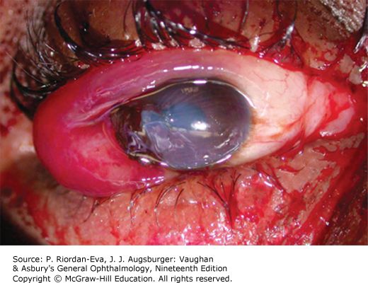 Full-thickness eye wall laceration &mdash; Cut clean through by a sharp object or high-velocity projectile