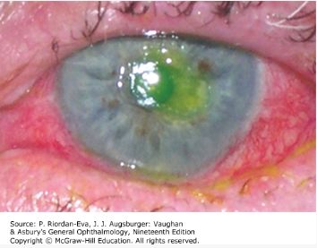 Corneal abrasion &mdash; Fluorescein staining the exposed basement membrane