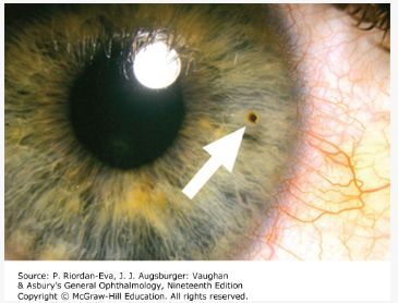 Corneal foreign body &mdash; Lodged after grinding or striking metal