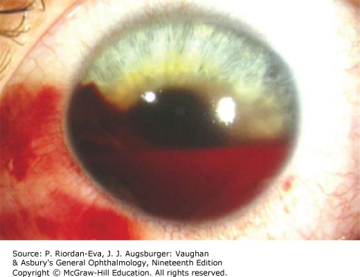 Hyphema &mdash; Blood layered in the anterior chamber, with a visible fluid level