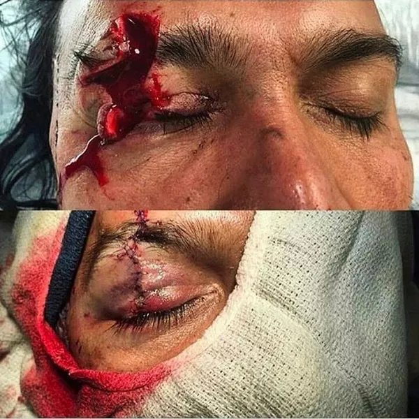 Lid laceration &mdash; Look underneath &mdash; two thirds of full-thickness cuts have a globe injury with them