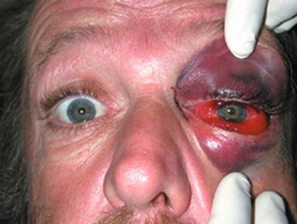 Orbital contusion &mdash; Swelling held in front of the septum, without hemorrhage