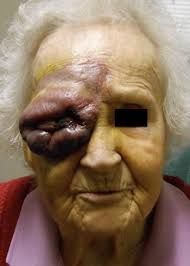 Periorbital hematoma &mdash; Bleeding behind the septum, within the bony orbit