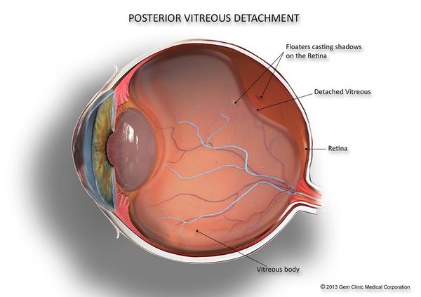 Posterior vitreous detachment &mdash; The event that usually precedes a rhegmatogenous detachment