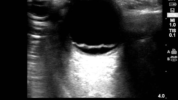 Retinal detachment on ultrasound &mdash; The detached retina as a bright membrane tethered in the vitreous cavity
