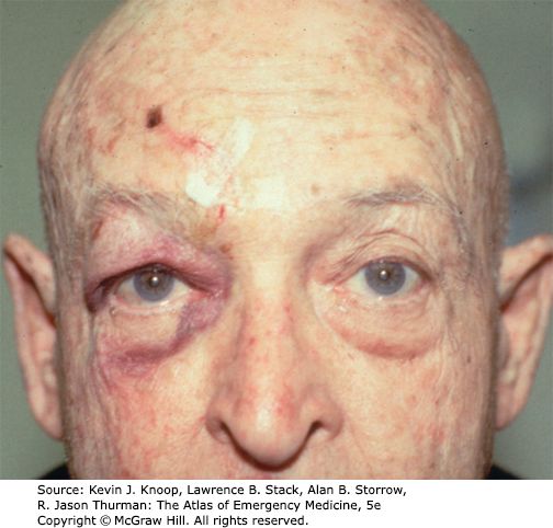 Orbital floor fracture &mdash; Periorbital ecchymosis and lid edema after blunt force