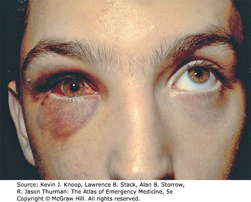 Inferior rectus entrapment &mdash; The right eye fails to elevate on upward gaze &mdash; diplopia looking up
